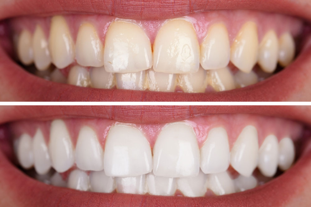 teeth whitening sydney